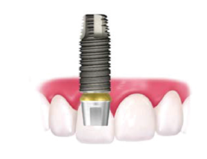Dental Implants In Parker, CO